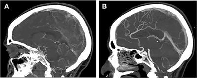 Case Report: Concomitant Massive Cerebral Venous Thrombosis and Internal Iliac Vein Thrombosis Related to Paucisymptomatic COVID-19 Infection